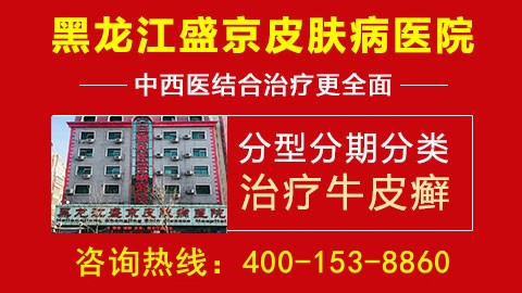 哈尔滨盛京医院能治牛皮癣吗